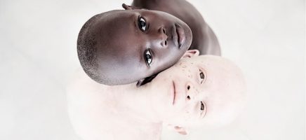 Beeldige foto's van albino kinderen in Tanzania die dagelijks ...