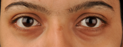 3 onverwachtse oorzaken van gezwollen oogleden
