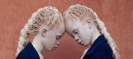 Deze 12-jarige albino tweeling verovert Social Media