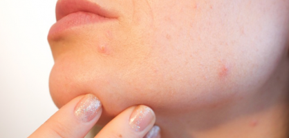 Dit is hoe je vervelende acne littekens kunt vervagen