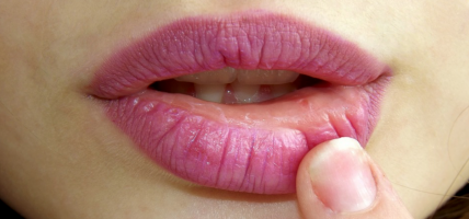 Zwellen je lippen regelmatig op na lip fillers met hyaluronzuur?